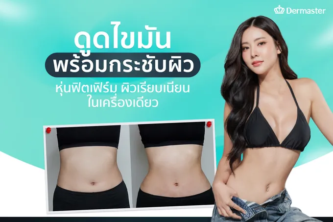 ดูดไขมัน พร้อมกระชับผิว หุ่นฟิตเฟิร์ม ผิวเรียบเนียนในเครื่องเดียว