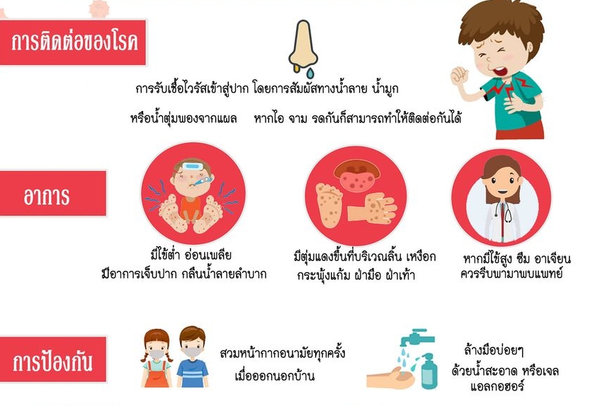 เตือน!โรคมือเท้าปากพบบ่อยในเด็กเล็ก/ยังไร้วัคซีนป้องกัน