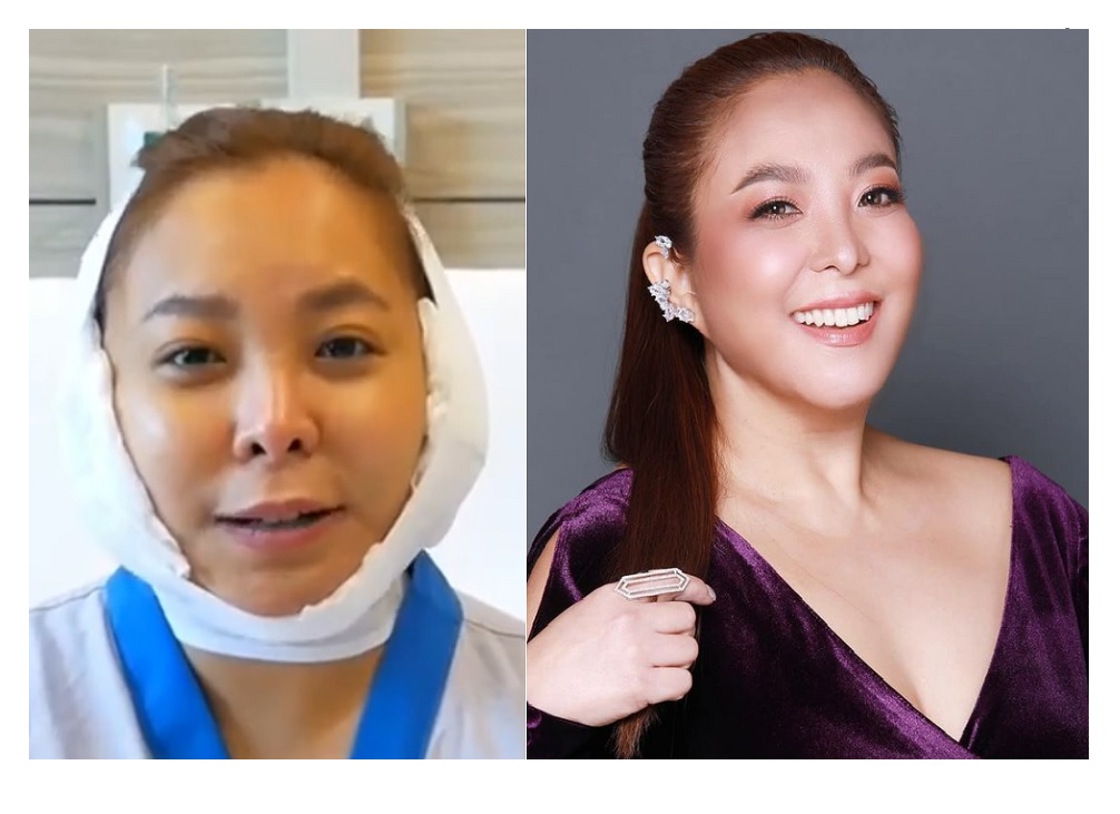 โฉมใหม่ 'ดีเจดาด้า' หลังศัลยกรรมครบ 3 เดือน  เป๊ะปัง หน้าเข้ารูปสวยเวอร์มาก