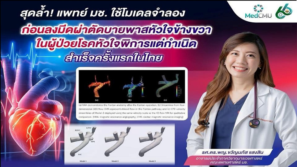สุดล้ำ! "แพทย์ มช."ใช้เทคโนโลยีโมเดลจำลองก่อนผ่าตัดบายพาสหัวใจ สำเร็จครั้งแรกในไทย