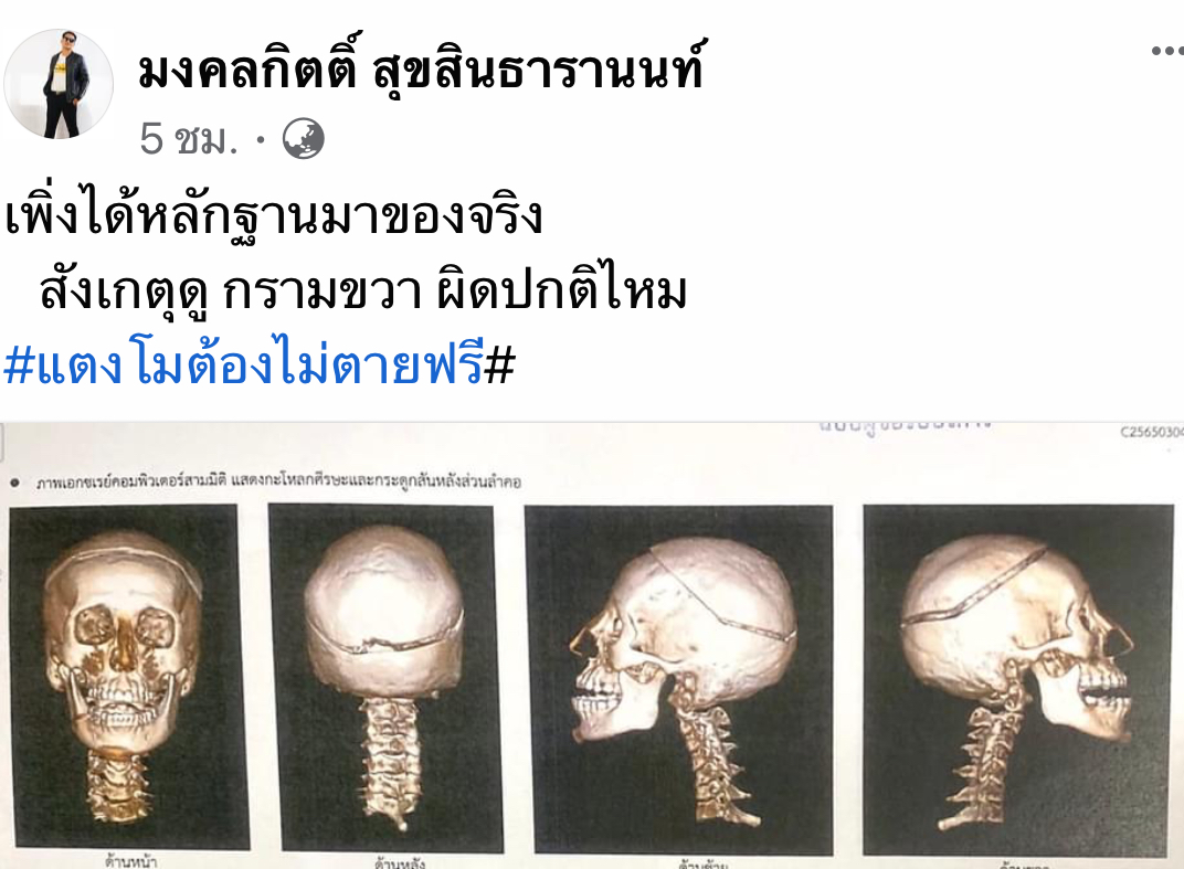 คดีแตงโม ไม่จบง่ายๆ "ส.ส.เต้" โพสต์ภาพฟิล์มเอ็กซ์เรย์ ระบุหลักฐานของจริง กรามขวาผิดปกติ