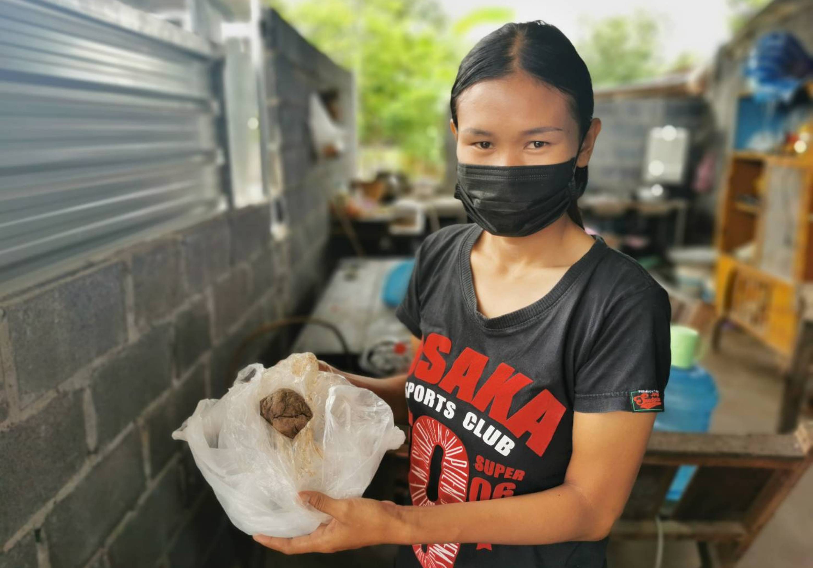  สาวแม่ลูกอ่อนผงะเจอผ้าก๊อซหลุจากช่องคลอด  คาดหมอลืมไว้ - รพ.พร้อมเยียวยา