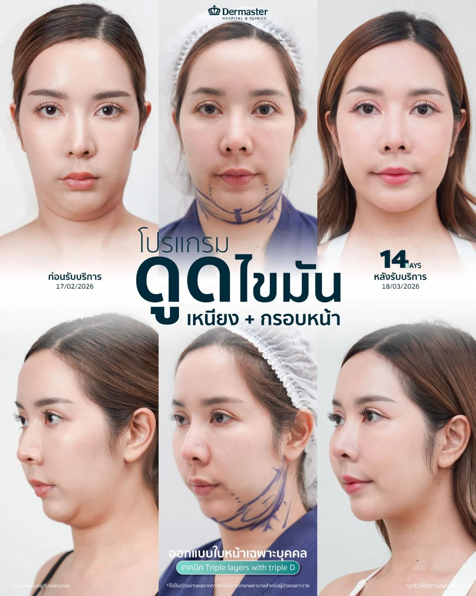 ตำแหน่งดูดไขมันพร้อมกระชับผิว