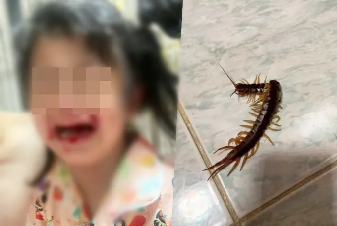 เตือนภัยหน้าฝน! หนูน้อยถูกตะขาบกัดเลือดอาบหน้า-หามส่งรพ.วุ่น