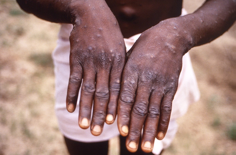 กทม.ห่วงฝีดาษลิงเพิ่ม เร่งควบคุมป้องกัน ชี้รักร่วมเพศ กลุ่มเอชไอวีเสี่ยงสูง