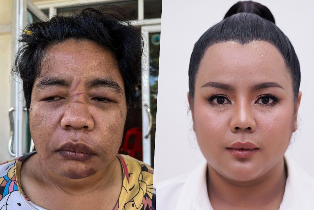 ฮือฮา! เปิดหน้าใหม่ “น้องเอ” อดีตทหารหญิงรับใช้ถูกทารุณจนเสียโฉม 
