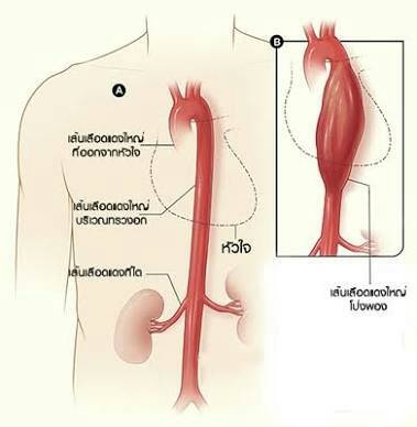 ไขประเด็นโซเชียล...แพทย์แนะตรวจสุขภาพ-ออกกำลังกาย ลดเสี่ยง “หลอดเลือดแดงใหญ่โป่งพอง”