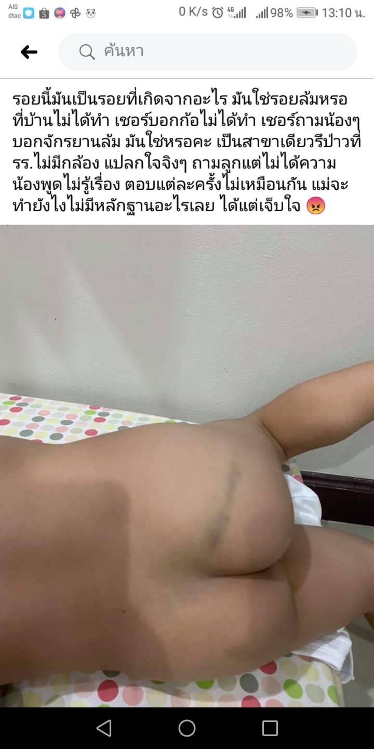 ฉาวไม่หยุดผู้ปกครองนักเรียน รร.เจ้าปัญหา สาขาธนบุรี แจ้งความหลังพบรอยช้ำคล้ายโดนไม้เรียวที่ก้นลูกชายวัยอนุบาล