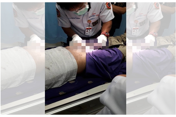 อุตริ! หนุ่มวัย 21  เจ้าโลกเน่าคาท่อเกลียว หลังสำเร็จความใคร่ จนเอาไม่ออก หมอต้องตัดทิ้ง
