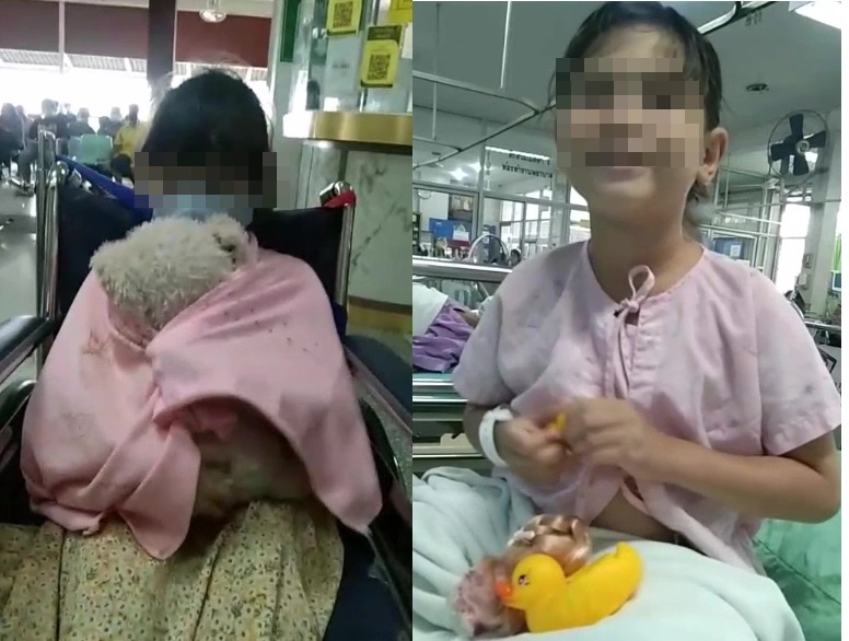 หมออุดรช่วยผ่าตัดตา'น้องแองเจิล'ลูกครึ่งไทย-อังกฤษจากเบาหวานขึ้นตาจนเกือบจะบอด