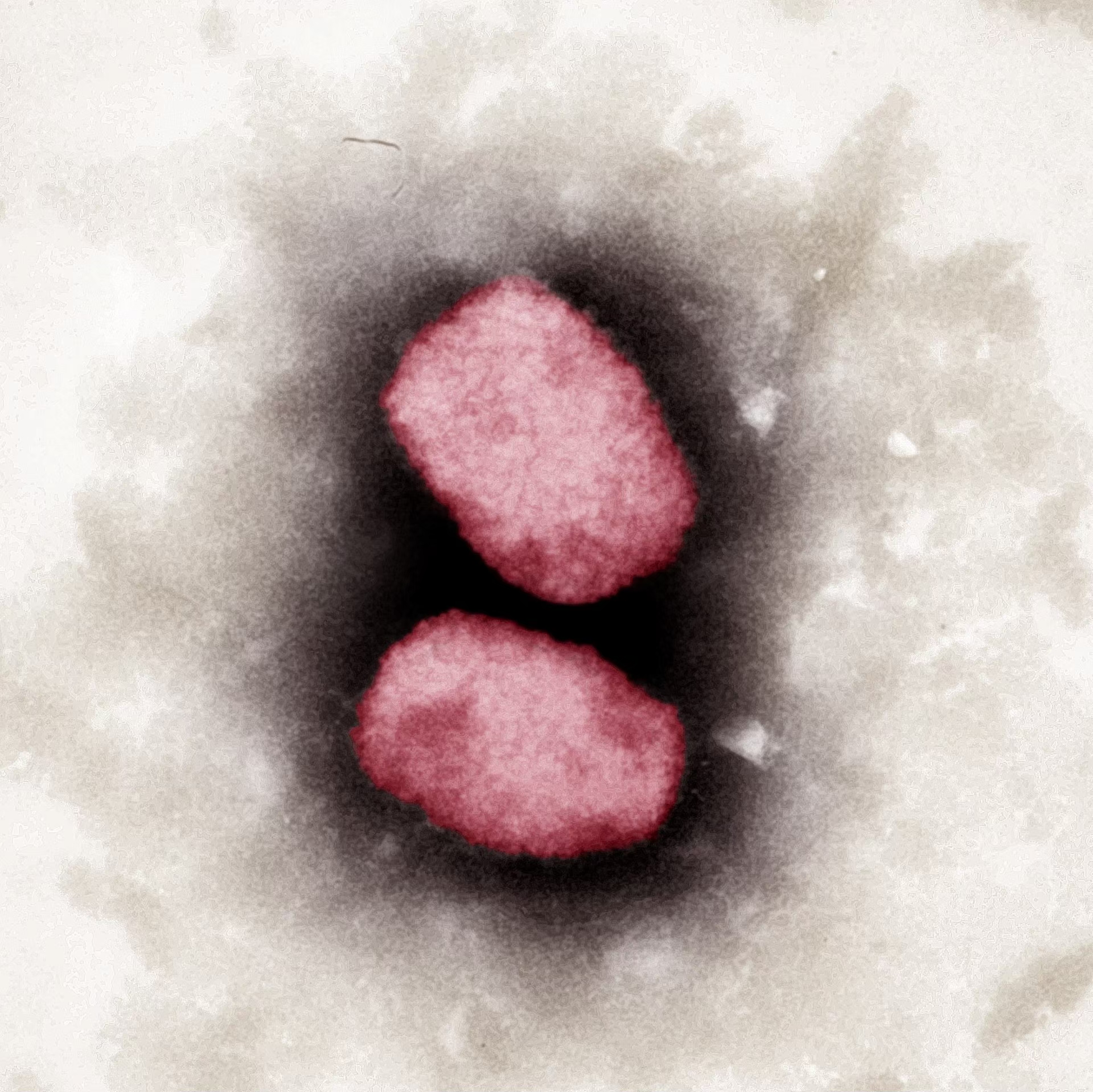 พบชายวัย 34 ติดเชื้อ HIV ภาวะภูมิคุ้มกันบกพร่อง ป่วย "ฝีดาษลิง" เสียชีวิตรายแรกในไทย 