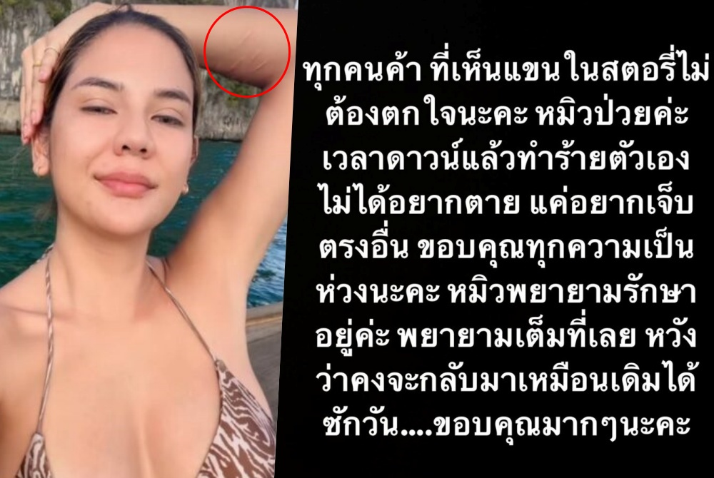  แค่อยากเจ็บ! “หมิว”แจงรอยแผลที่แขน รับป่วยทำร้ายตัวเองเวลาดาวน์ 