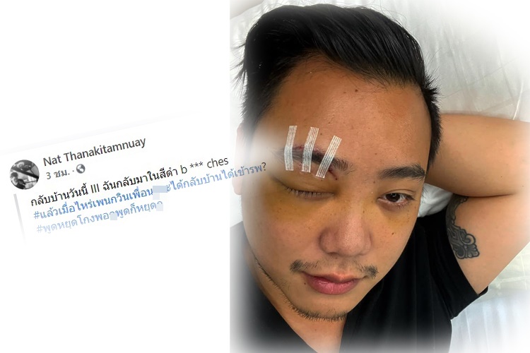  "ไฮโซลูกนัท"โพสต์ภาพล่าสุด หลังรักษาดวงตา ลั่น "ผมกลับมาแล้ว"