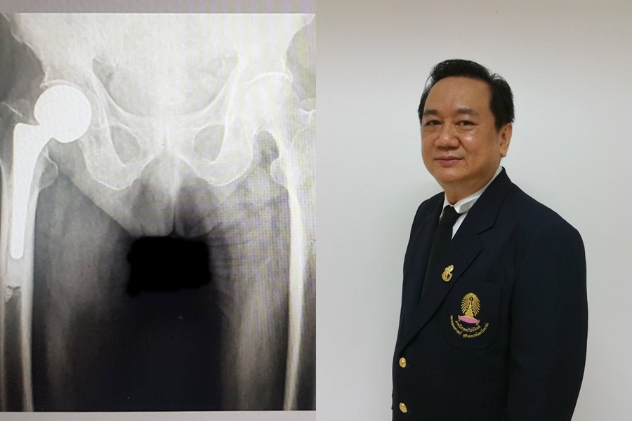ครั้งแรก!ไทย ทีมแพทย์-วิศวะจุฬาฯ         ผลิตข้อสะโพกเทียมเพื่อผู้สูงวัย คุณภาพดี-ราคาถูก 