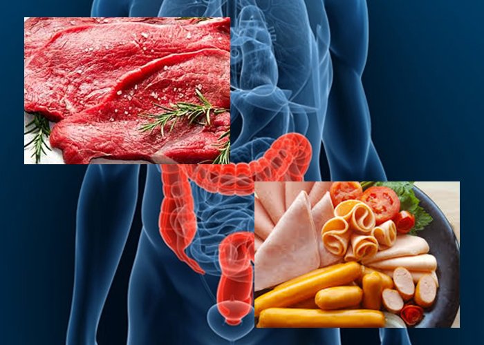 ฟันธงคอนเฟิร์ม! กินเนื้อแดง-อาหารแปรรูปแถม!มะเร็งลำไส้ใหญ่
