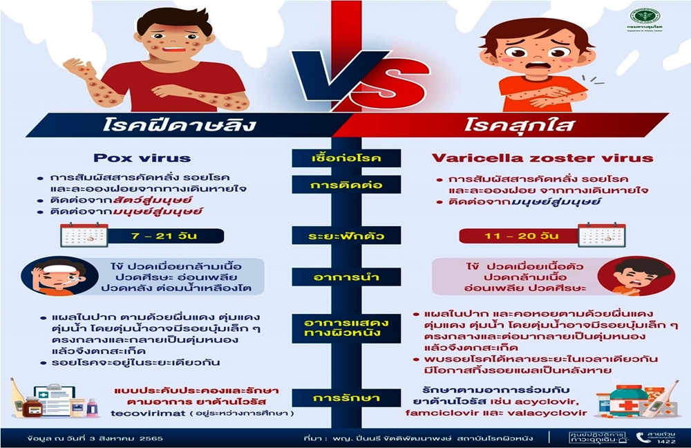 จะรู้ได้ยังไง ว่าเป็น "ฝีดาษลิง" หรือ "อีสุกอีใส" เช็กที่นี่!