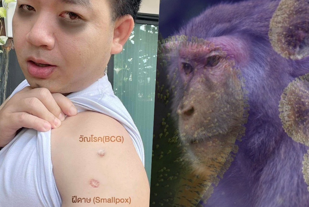 'หมอแล็บแพนด้า'เตือน'โรคฝีดาษลิง'ไม่ใช่เรื่องไกลตัว ชวนถกแขนเสื้อเช็กปลูกฝี