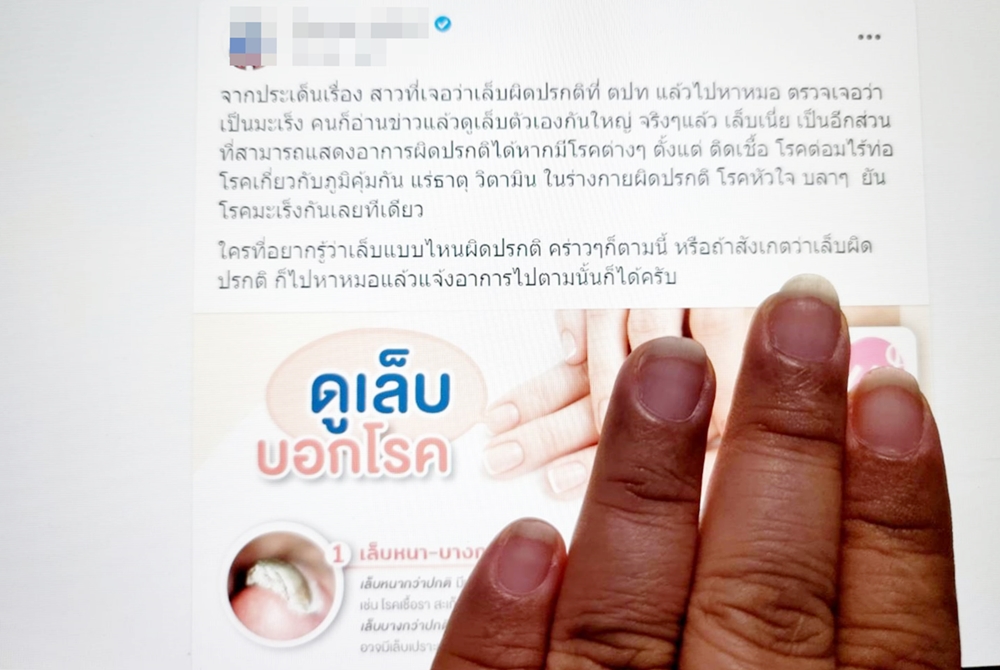 เพจดังเตือนเล็บขึ้นขีดบ่งชี้ความผิดปกติหลายโรค ยันมะเร็ง