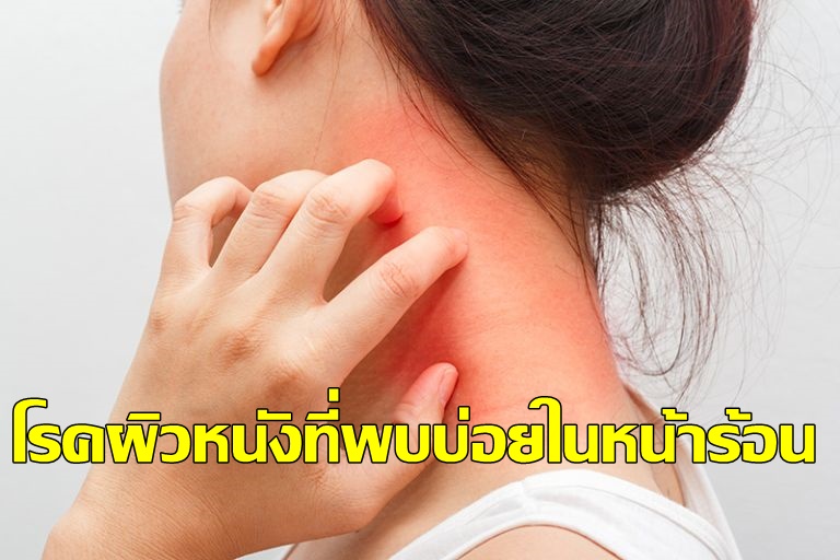 โรคผิวหนังที่พบบ่อยในหน้าร้อน