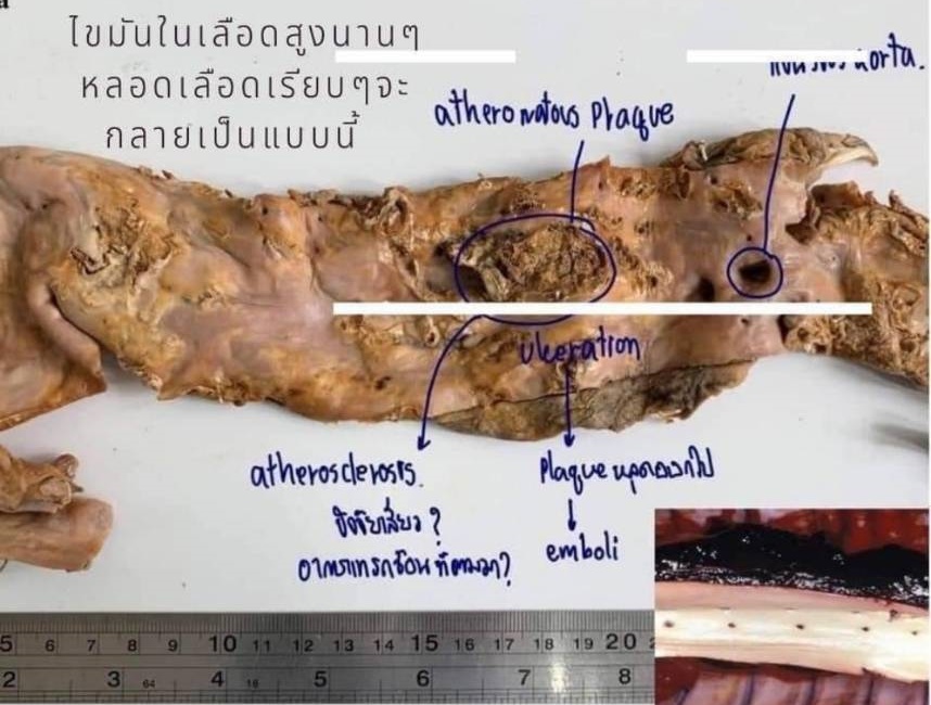 ดับไม่ทันตั้งตัว! เพจ “เรียนหมอ” เตือนอุทาหรณ์ “สายปิ้งย่าง” ปล่อยหลอดเลือดสะสมไขมันสูง
