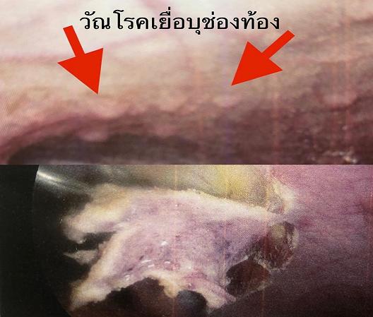 “วัณโรคเยื่อบุช่องท้อง” พบน้อย-วินิจฉัยยาก
