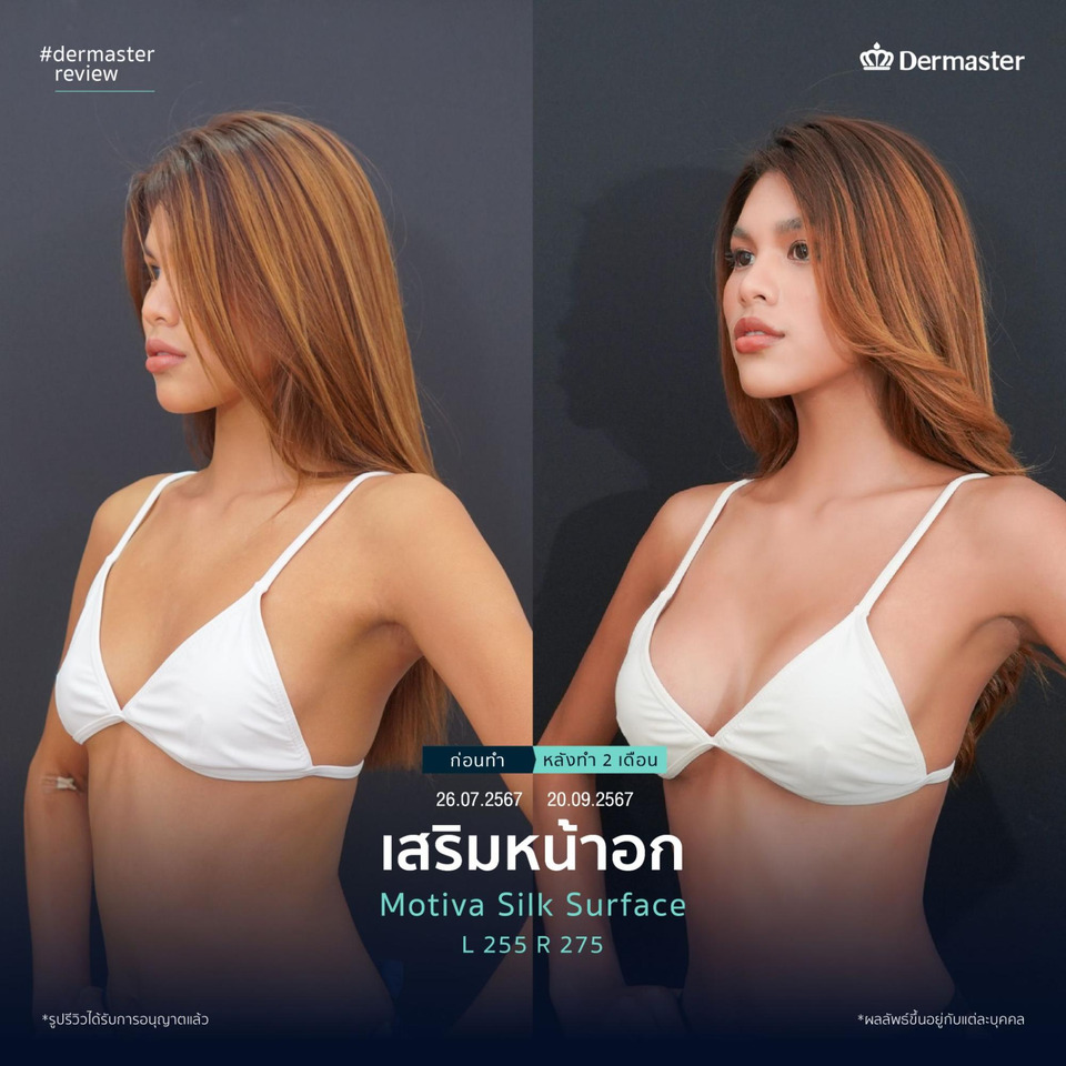 เตรีมตัวก่อนเสริมหน้าอก