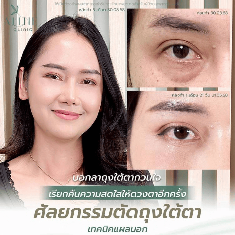 รีวิวผ่าตัดถุงใต้ตาที่ ALINE Clinic